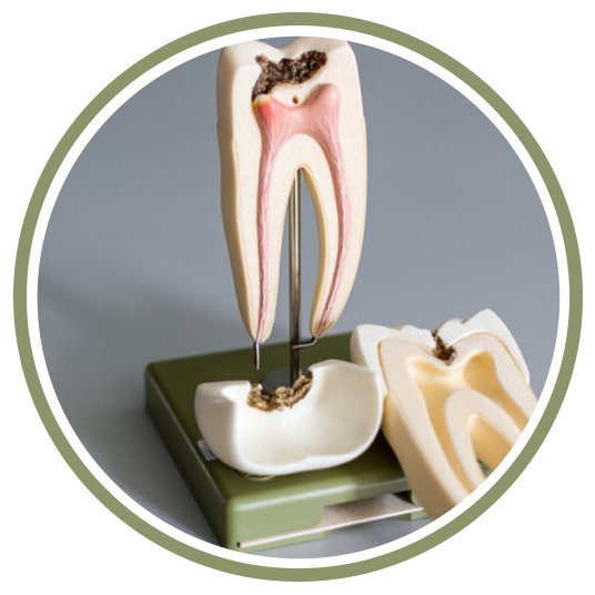Clareamento Dental Interno